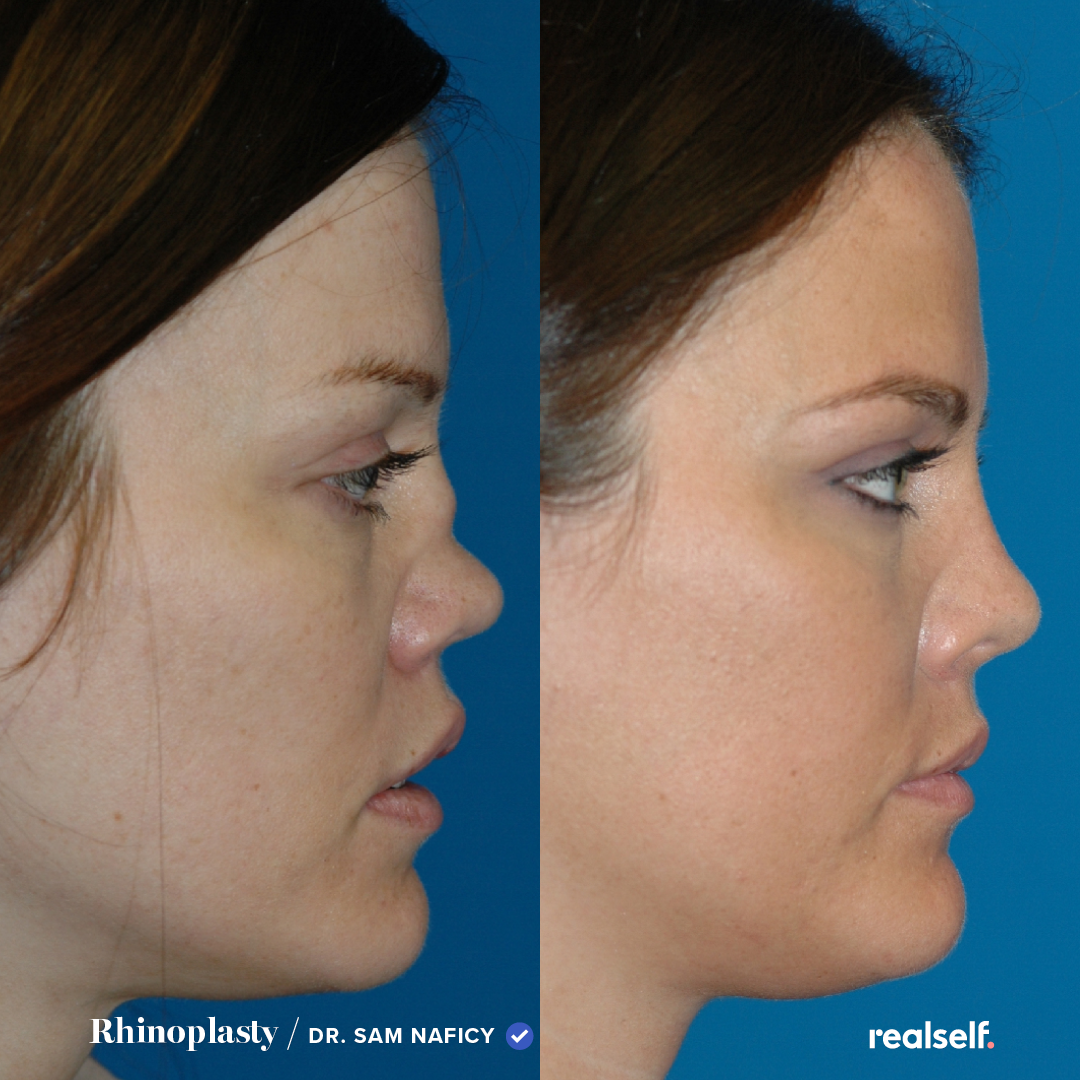 This is your best chance to get a nose job cost that is right for your budget. post thumbnail image