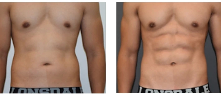How come liposuction significant? post thumbnail image