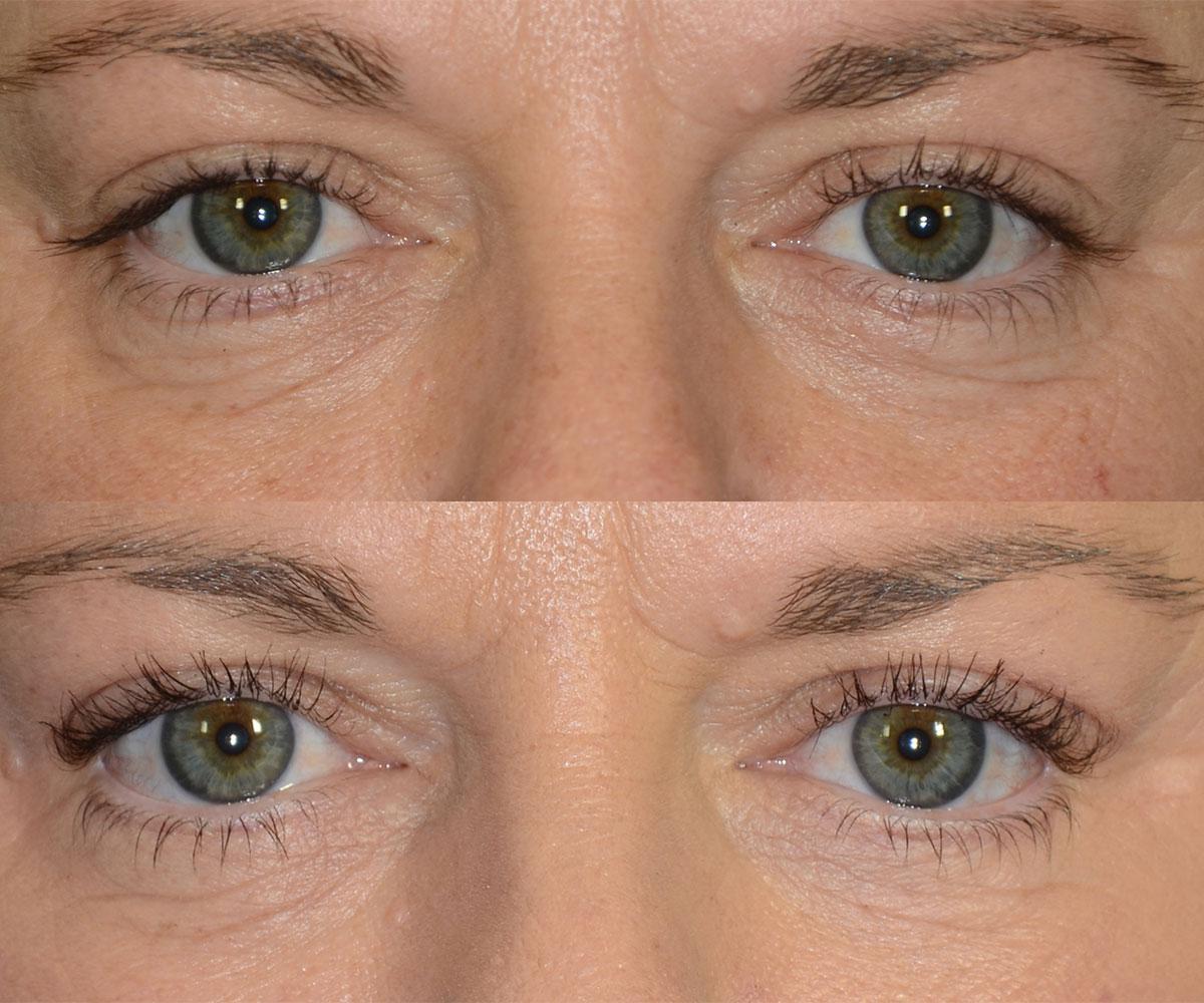 Hate the Excess Skin Around Your Eyes? Get the Best Eyelid Surgery Santa Barbara post thumbnail image
