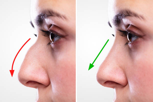 The liquid nose job Beverly Hills delivers a uncomplicated and soreness-free of charge surgical procedure post thumbnail image